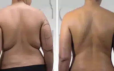 How To Prepare For A Body Contouring Session: What You Need To Know