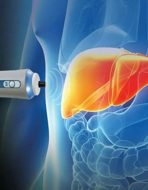fibroscan-1-560x720 fibroscan 1 560x720 1