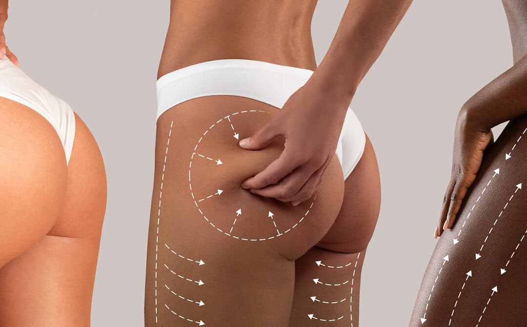 A Comparison Of Body Contouring Methods