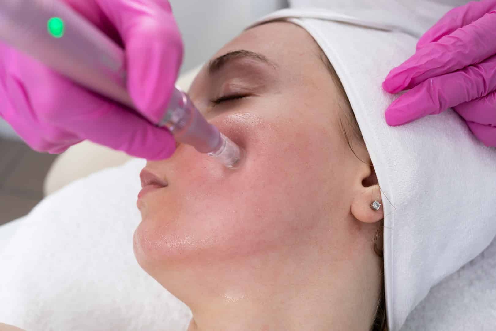 micro needling